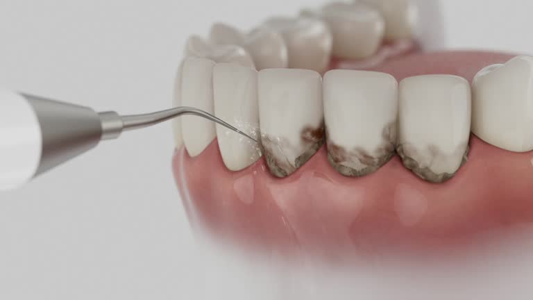 Trusted Wisdom Tooth Removal service in Las Lomas, CA - Dentist Open Now